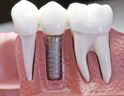 Ce este implantul dentar?